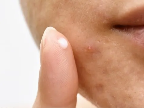 Acne Jacksonville Beach FL