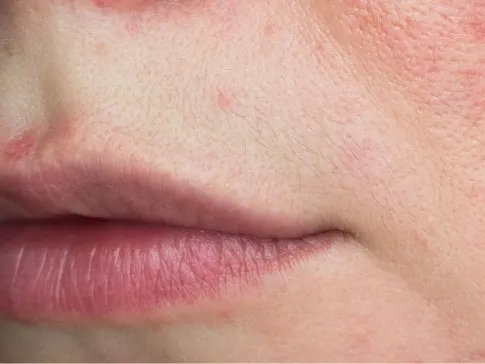 Rosacea Treatment Jacksonville Beach FL