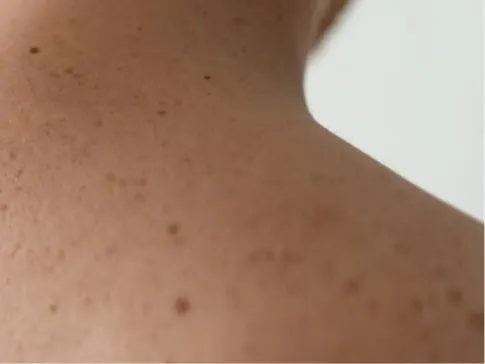 Moles and Birthmarks Jacksonville Beach FL