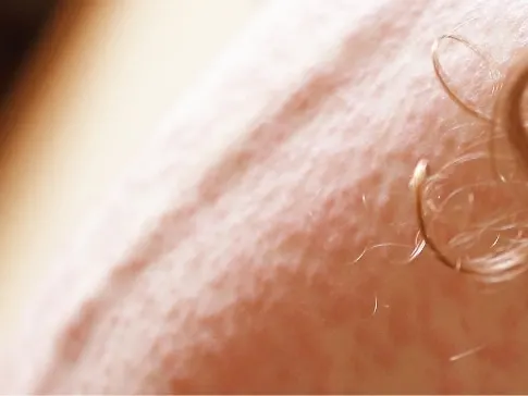 Psoriasis Jacksonville Beach FL