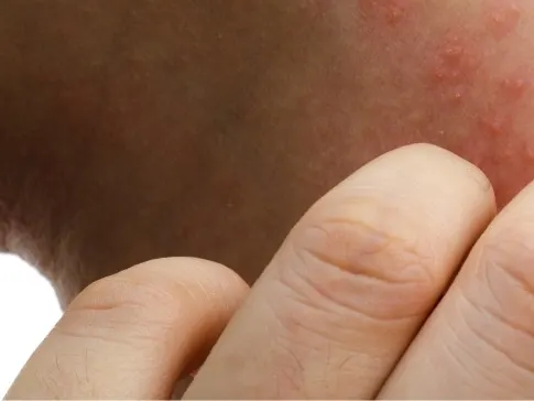 Contact Dermatitis Jacksonville Beach FL