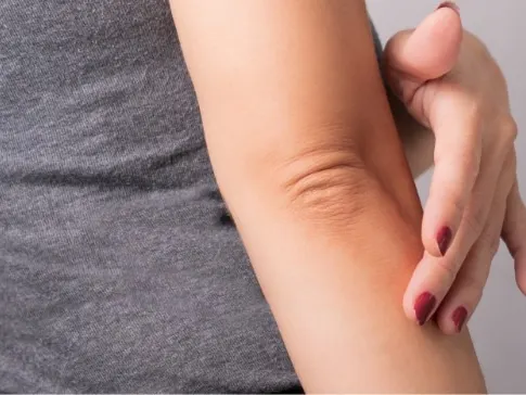 Eczema Jacksonville Beach FL