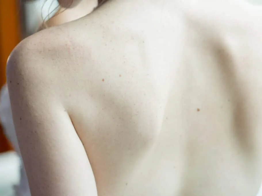 Close view of a patient’s bare back during a skin check