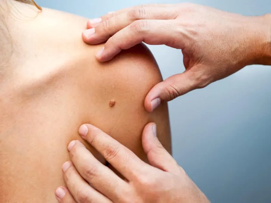 Clinician’s hands examining a mole on a patient’s shoulder