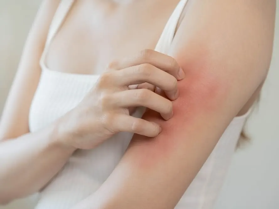Woman scratching a red, irritated patch on her upper arm