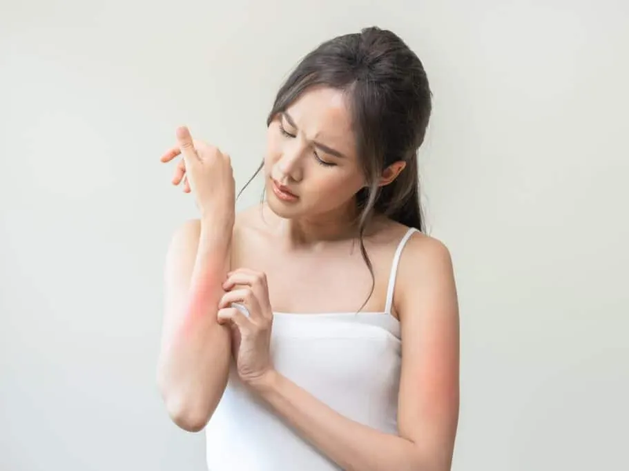 Woman scratching her red, inflamed forearm