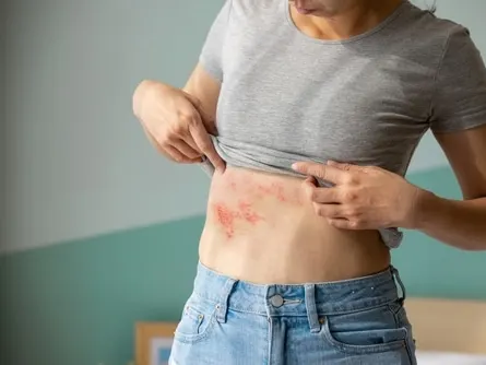 Woman with shingles on the skin she feels very painful