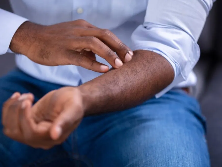 Professional African-American man scratching his hand due to a psoriasis flare up in Jacksonville Beach, FL