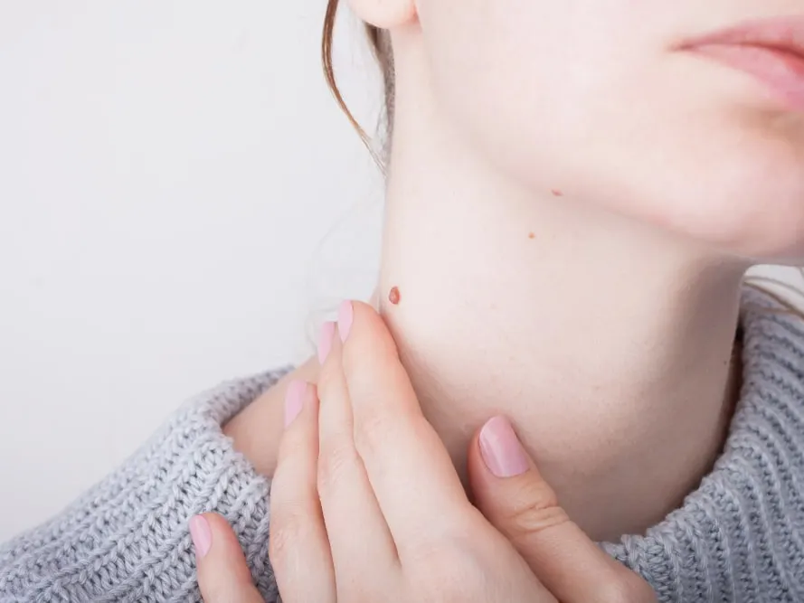 Close up of large mole on woman's neck during home skin exam.