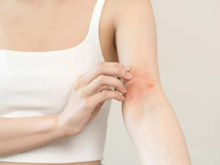 Woman itching red rash on her arm due to spring skin allergies.