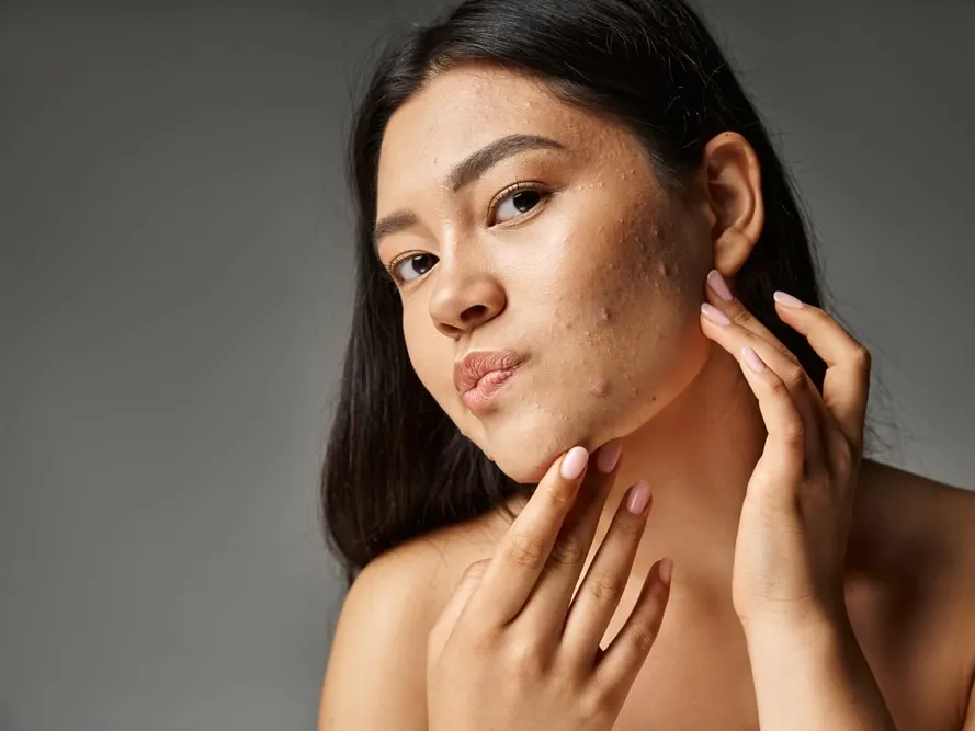 Adult woman with acne breakout on face