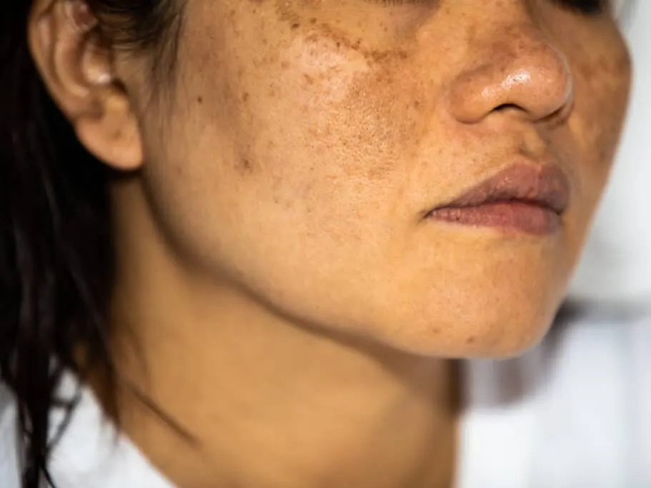 Close-up of young woman's face showing discoloration from melasma