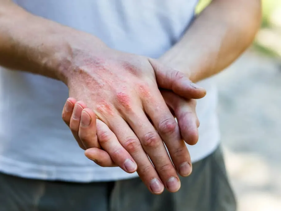 Person holding irritated, red, scaly skin on the back of one hand from psoriasis
