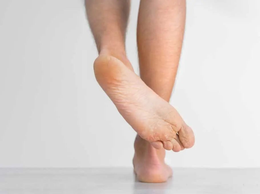 Bottom of a person’s foot showing peeling, cracked skin that may be a symptom of Athlete’s Foot