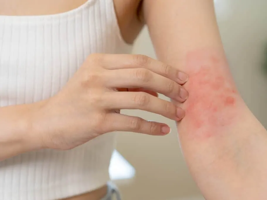 Woman scratching eczema flareup on her inner elbow