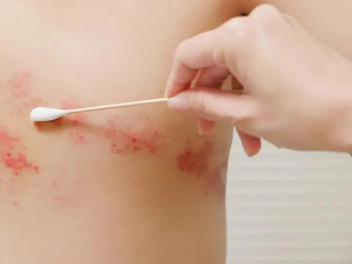 Doctor taking a swap of rash on person's back to test for shingles.