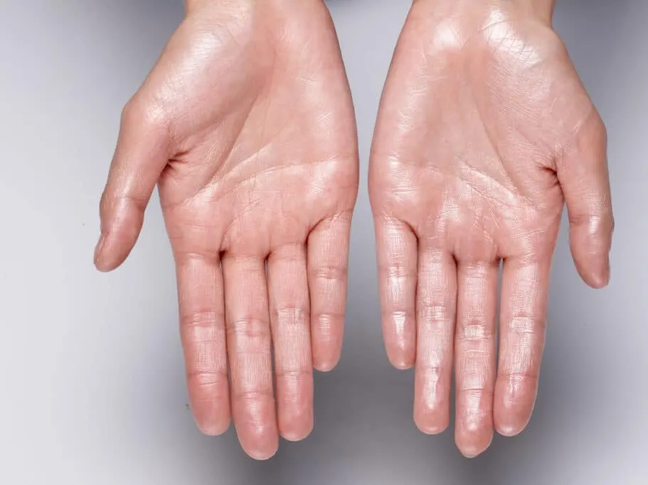 Person with sweaty hands due to hyperhidrosis