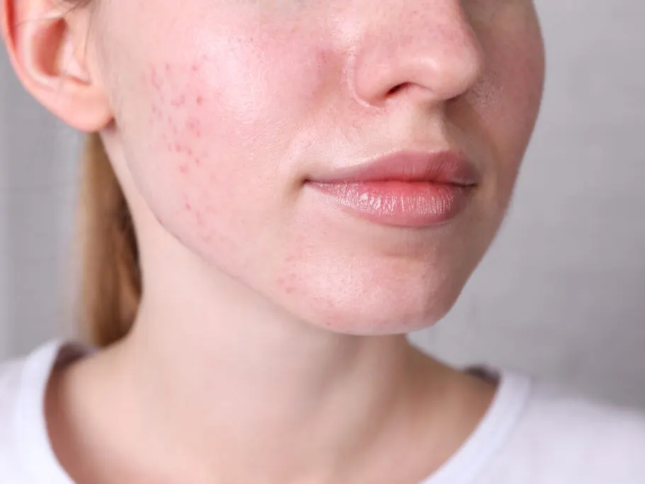 Woman examining facial redness and rosacea symptoms.