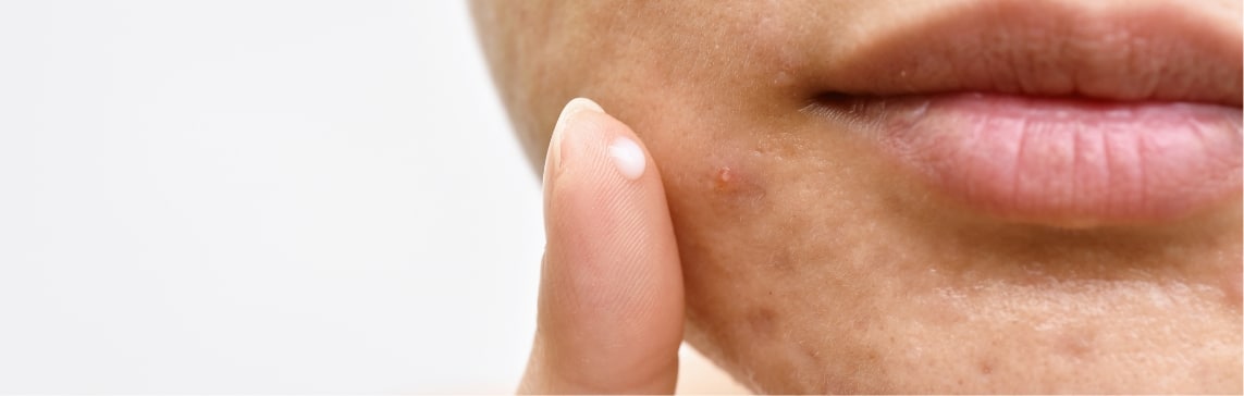 Acne Jacksonville Beach FL