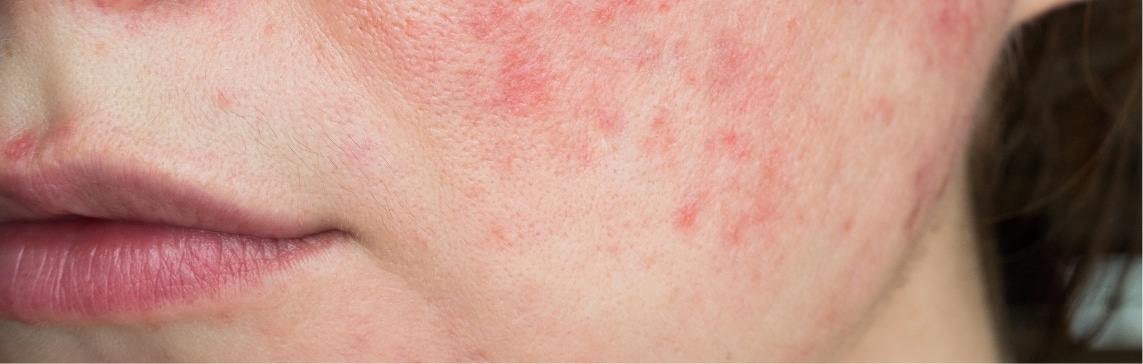 Rosacea Treatment Jacksonville Beach FL