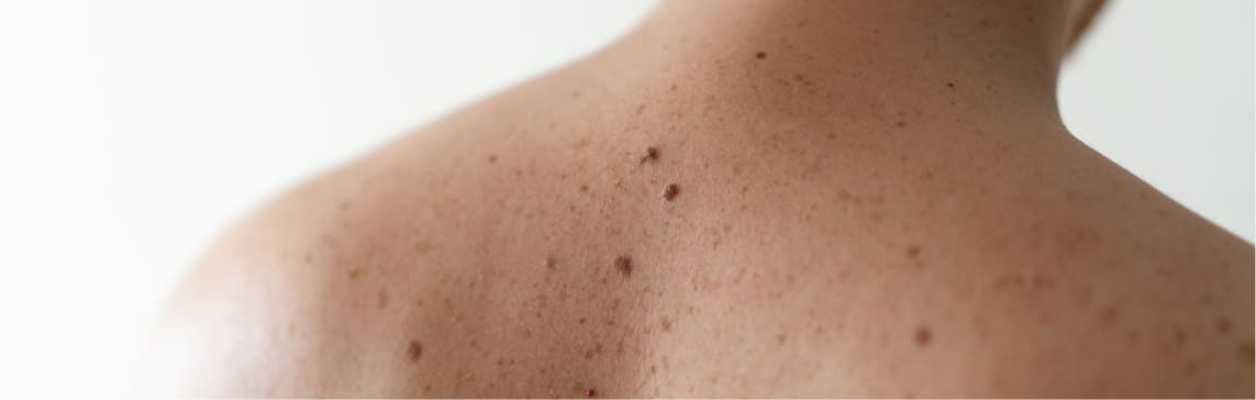 Moles and Birthmarks Jacksonville Beach FL
