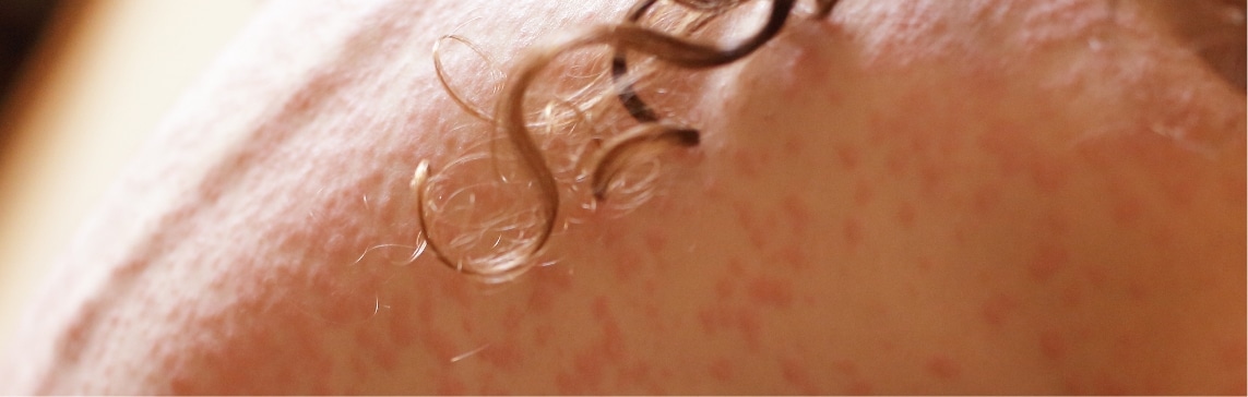 Psoriasis Jacksonville Beach FL