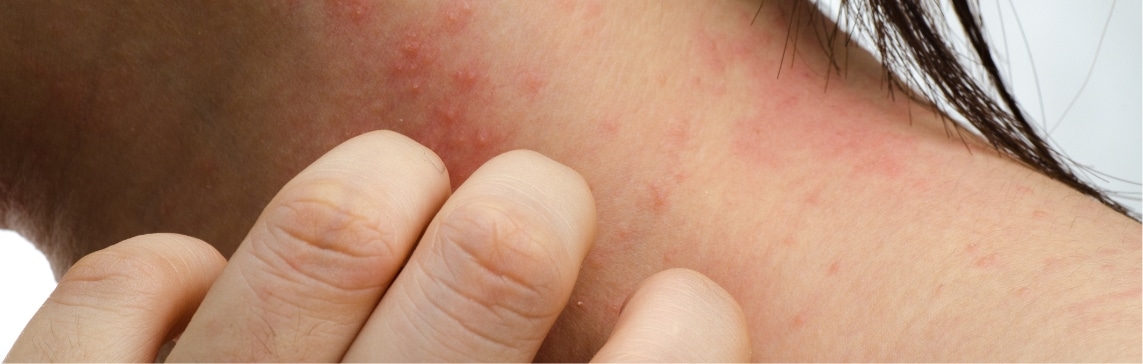 Contact Dermatitis Jacksonville Beach FL