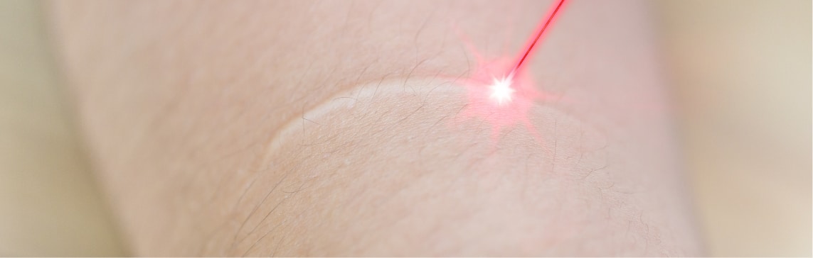 Scar Revision Jacksonville Beach FL