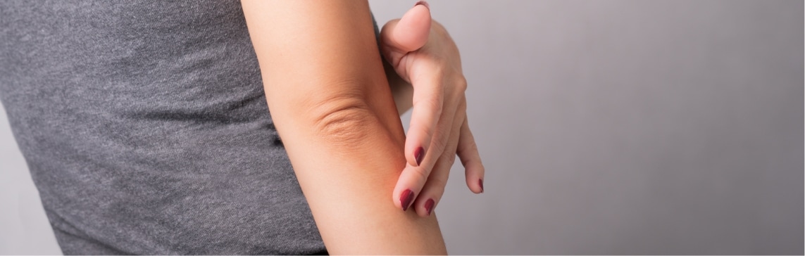 Eczema Jacksonville Beach FL