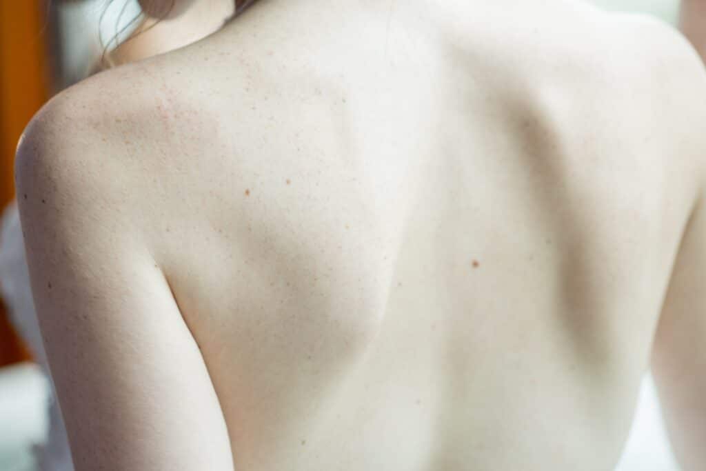 Close view of a patient’s bare back during a skin check