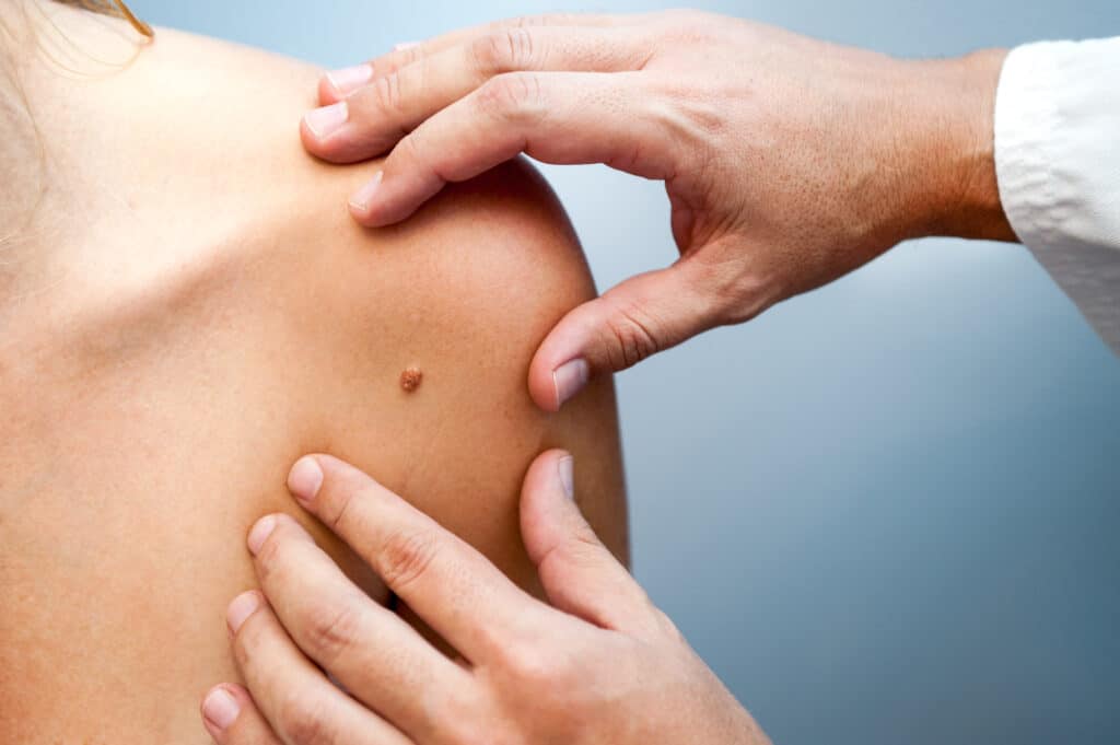 Clinician’s hands examining a mole on a patient’s shoulder