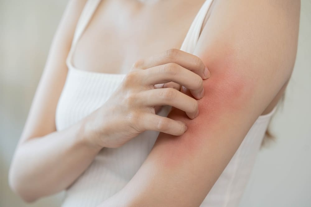Woman scratching a red, irritated patch on her upper arm