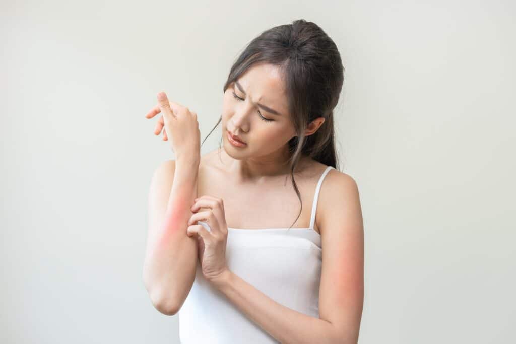 Woman scratching her red, inflamed forearm