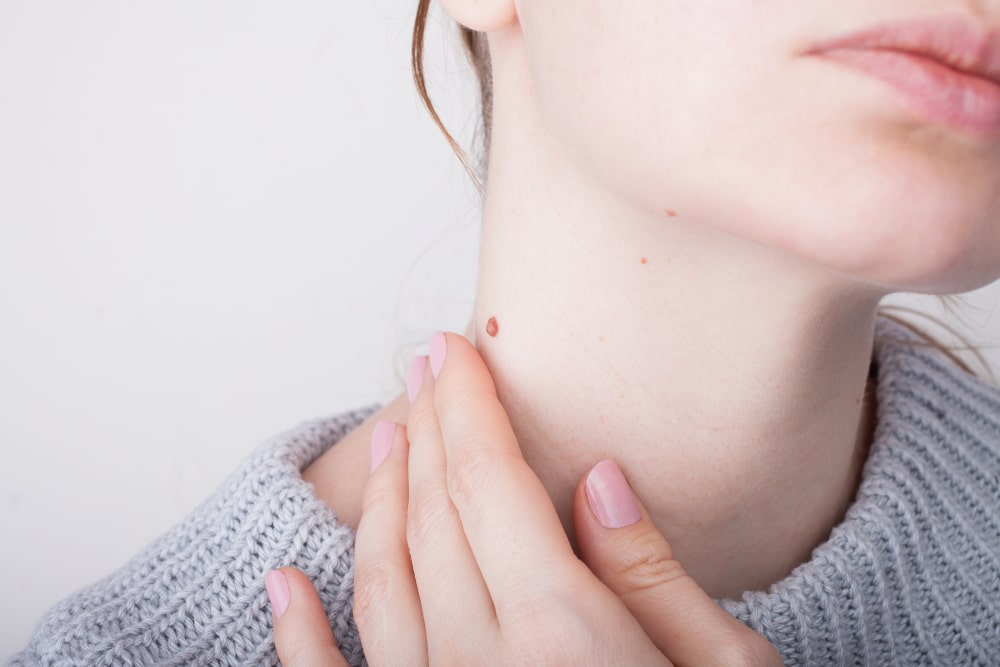 Close up of large mole on woman's neck during home skin exam.