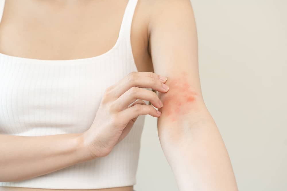 Woman itching red rash on her arm due to spring skin allergies.