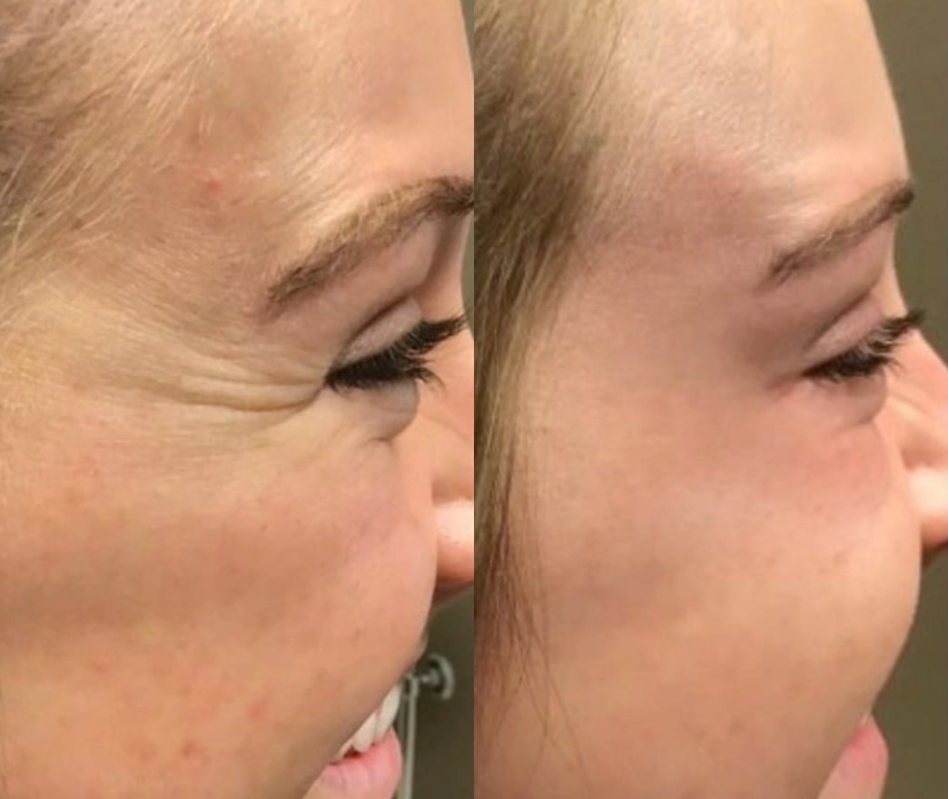 Before and after Botox, side view: lines around the eye on the left, a smoother eye area on the right