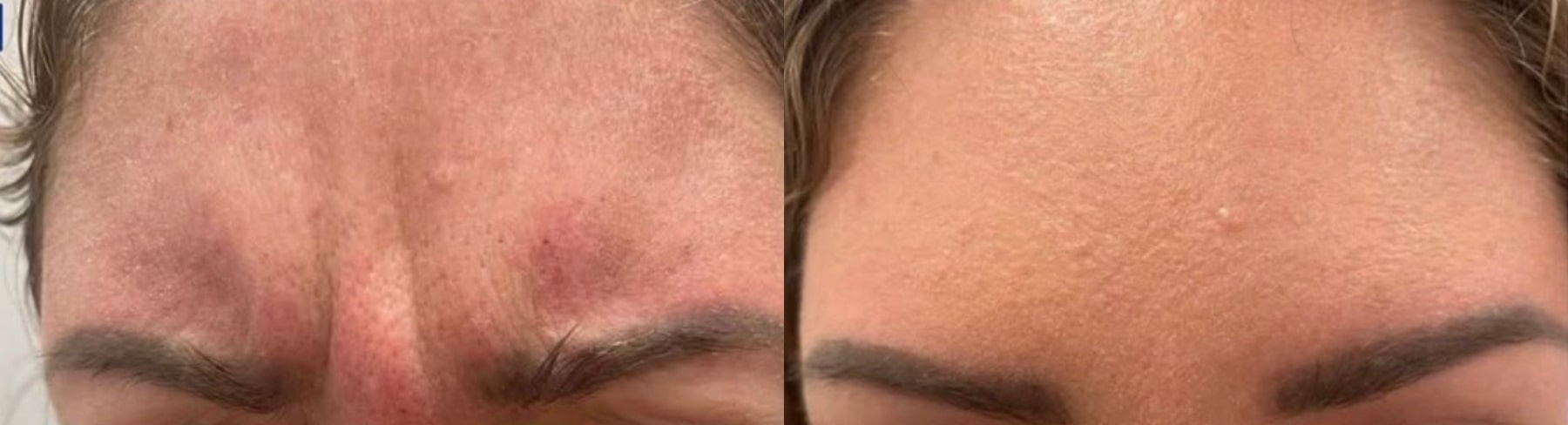 Before and after Botox, front view: frown lines between the brows on the left, a smooth forehead on the right