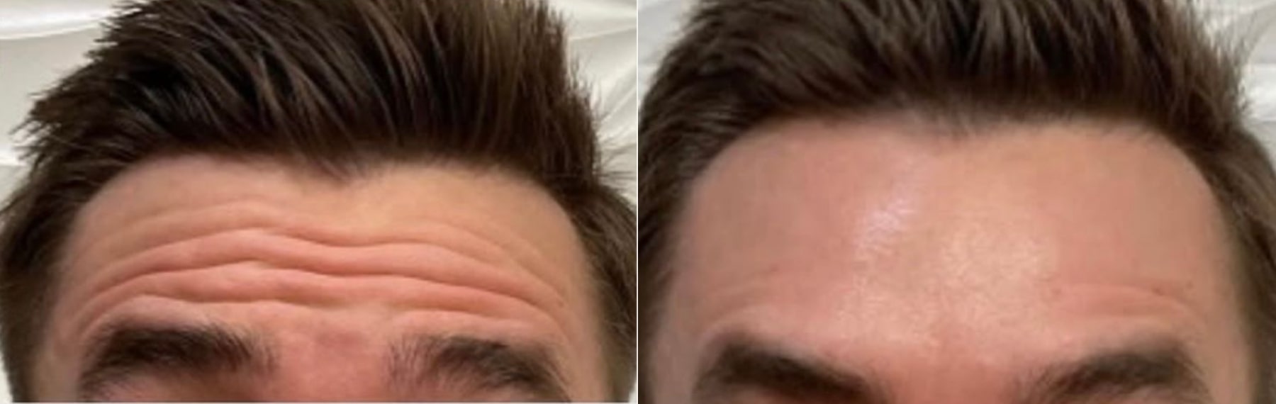 Before and after Botox, front view: deep forehead lines on the left, a smooth forehead on the right