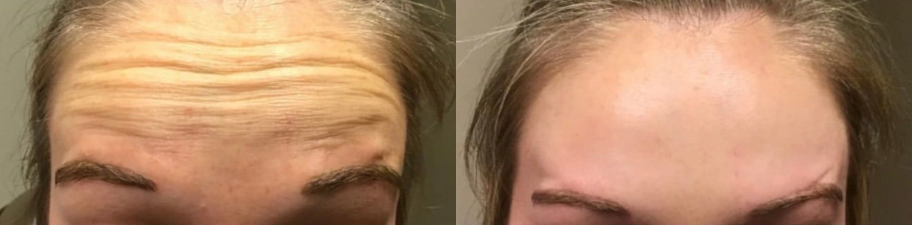 Before and after Botox, front view: forehead lines on the left, a smoother forehead on the right