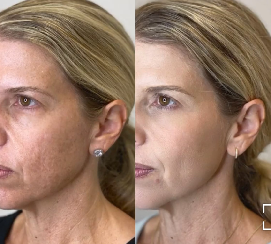 Before and after a chemical peel, left side view of the face: uneven, textured skin on the left, a more even complexion on the right