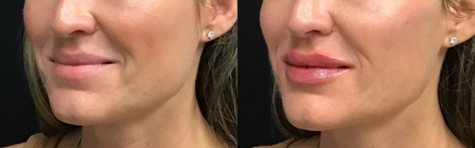 Before and after filler, three-quarter view of the lower face: thinner lips on the left, fuller defined lips on the right