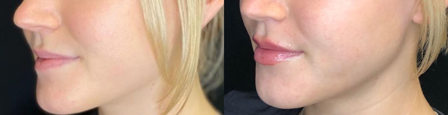 Before and after filler, side view of the face: natural lips on the left, fuller lips on the right
