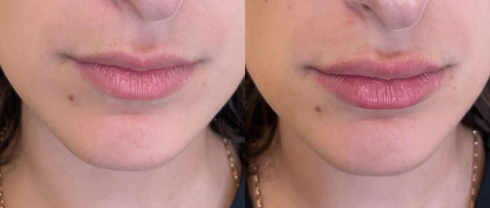Before and after filler, front view of the lower face: natural lips on the left, fuller lips on the right