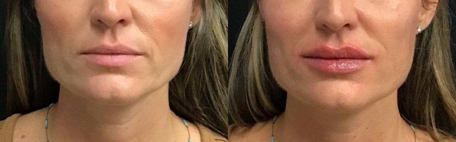 Before and after filler, front view of the lower face: thinner lips on the left, fuller lips on the right