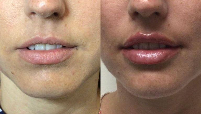 Before and after filler, close front view of the mouth: natural lips on the left, fuller lips on the right