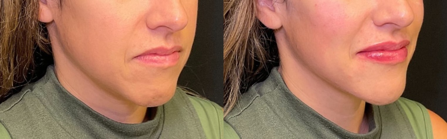 Before and after filler, three-quarter view of the lower face: natural lips on the left, fuller lips on the right