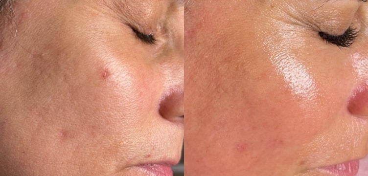 Before and after microneedling, close view of the cheek: visible marks and redness on the left, clearer skin on the right