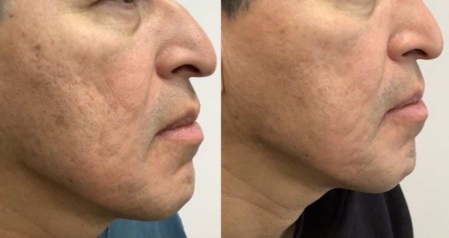 Before and after microneedling, right side view of the face: textured cheek skin on the left, smoother skin on the right