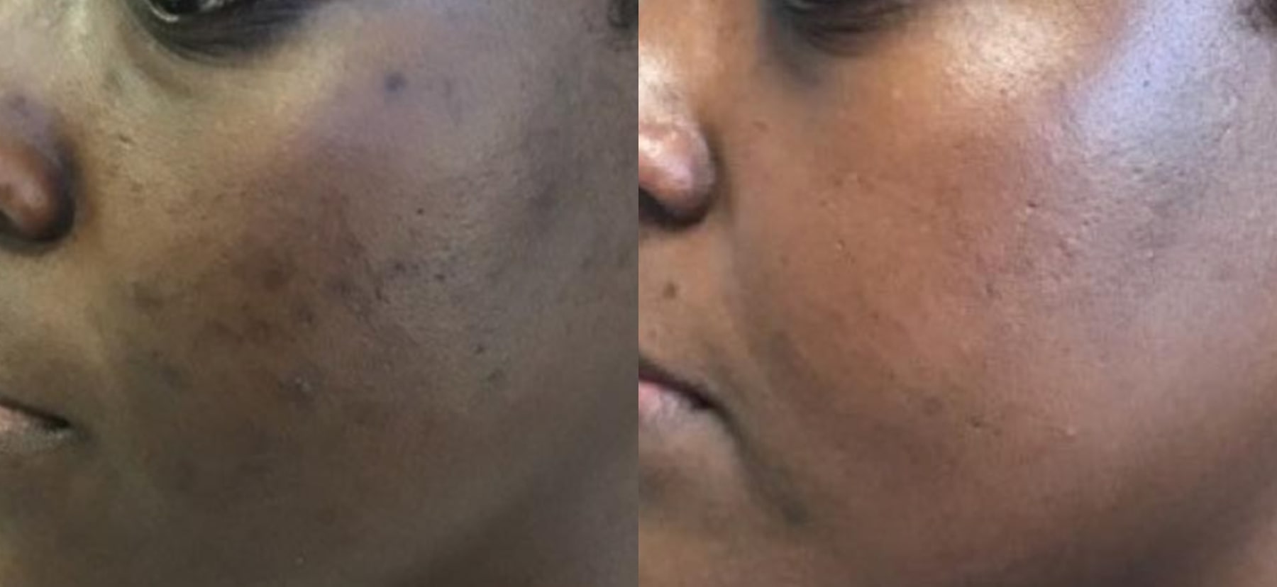 Before and after microneedling, left side view of the face: dark marks on the cheek on the left, a more even skin tone on the right