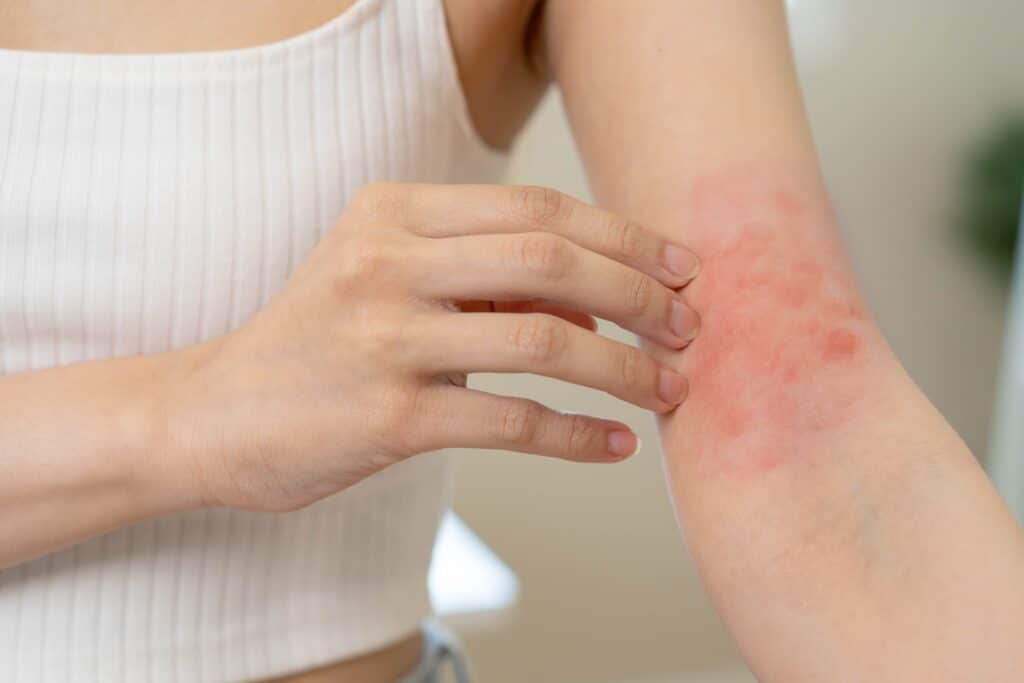Woman scratching eczema flareup on her inner elbow